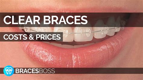 Clear Braces Cost & Prices - Full Pro Guide 2025 - BracesBoss
