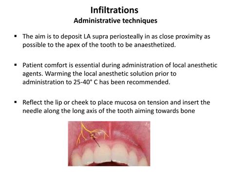 Infiltration Anesthesia 的图像结果