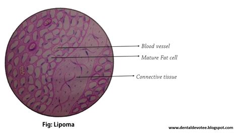 Dentosphere : World of Dentistry: Oral Pathology Histopathological ...