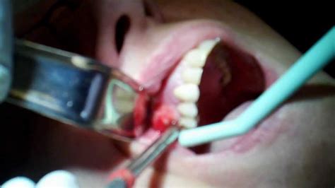 Bildergebnis für abscess tooth popped in mouth