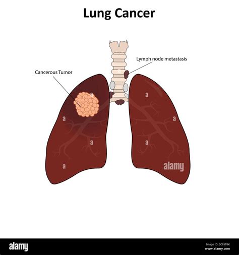 Illustration structure pulmonary alveoli hi-res stock photography and ...