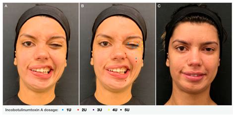 Botulinum Toxin Type A to Improve Facial Symmetry in Facial Palsy: A ...