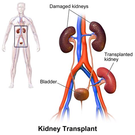 Kidney Transplant | UCSF Department of Surgery