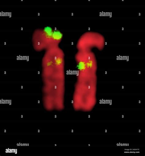 Smith-Magenis syndrome chromosomes. Fluorescence in situ hybridisation ...