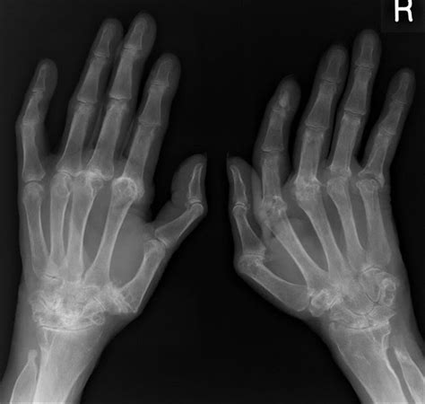 Sagittal Band Rupture - Hand - Orthobullets