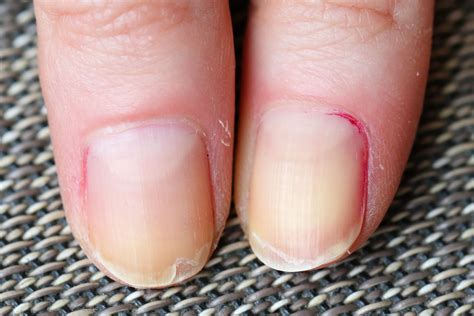Fingernails : A Window To Gut Health - Nail Changes In Gluten ...