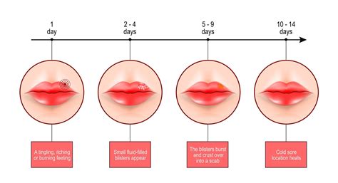Cold Sore Stages Ocular Herpes (Eye Herpes): Symptoms & Treatment