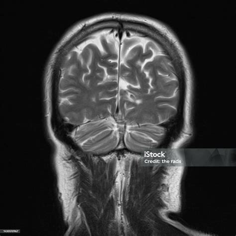 Normal Brain Mri Images Stock Photo - Download Image Now - Anatomy, Black And White, Brain Stem ...