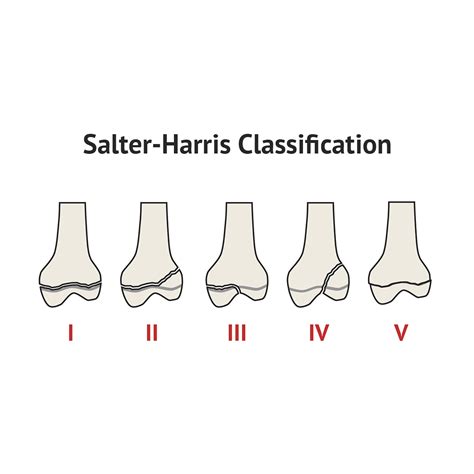Salter-Harris Classification of Fractures | Classification, Human body anatomy, Topic outline