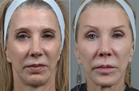 CO2 Laser Skin Resurfacing in Birmingham, AL | Seiler Skin