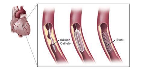 Dr Ripen Gupta | Official Website | Best Cardiologist in Delhi