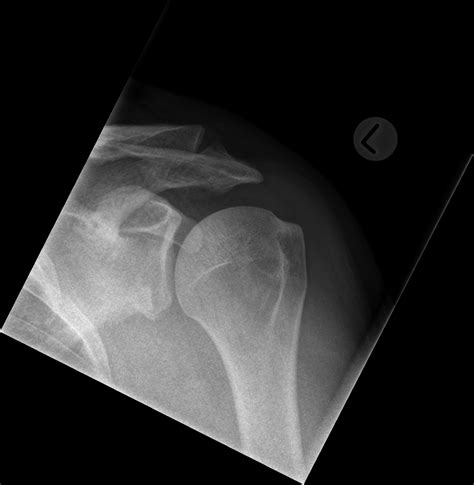 Bankart E Hill Sachs