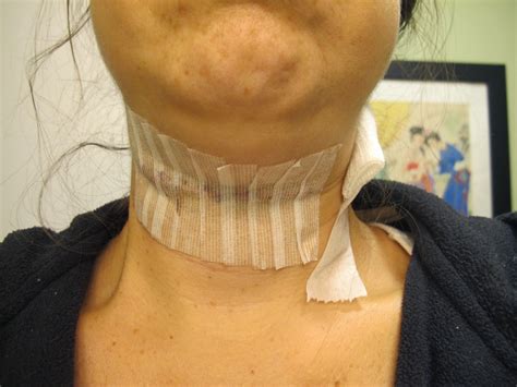 Linguine or Lo Mein?: Thyroglossal Duct Cyst - Sistrunk Procedure