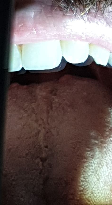 Background: i have crohn's disease and i believe this is oral thrush. Symptoms: White patchy ...