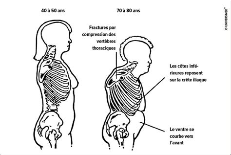 Thérapie de l’ostéoporose chez le sujet très âgé - Contenu en francais ...