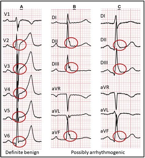 J-Wave Syndromes - Cardiac Electrophysiology Clinics
