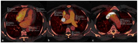 Detection of Low Blood Hemoglobin Levels on Pulmonary CT Angiography: A ...