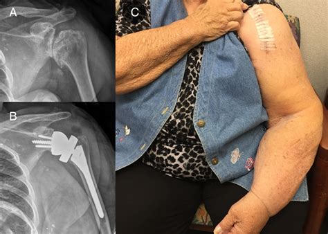 Shoulder Replacement in Patients with Lymphedema: How Dangerous Is it? - Shoulder & Elbow