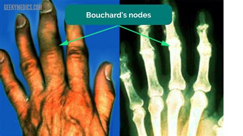 GALS Examination OSCE Guide | Gait, Arms, Legs, Spine | Geeky Medics