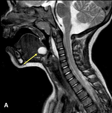 Thyroglossal Duct Cyst (TDC) - MRI Online / Medality