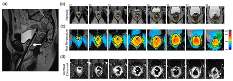 Real-Time MRI-Guided Prostate Interventions