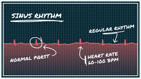 Normal Sinus Ekg What Defines A True Normal Sinus Rhythm On A 12 Lead