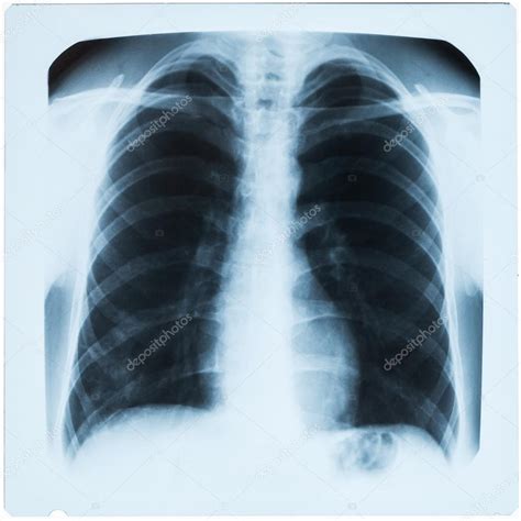 X-ray of male chest during pneumonia — Stock Photo © deymosd #39863157