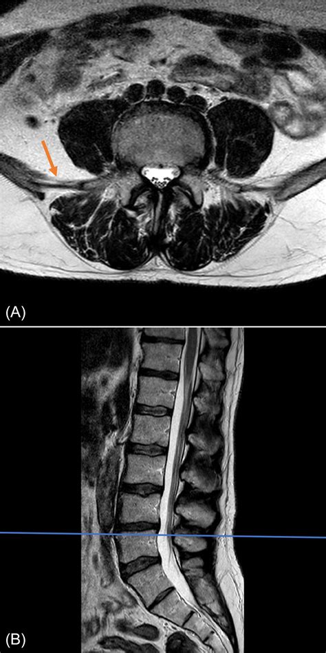 Types Of Lumbar Spine Mri - Design Talk