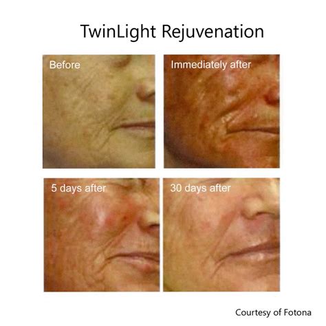 Medaglia Sentimentale Passivo skin firming laser ossigeno benedizione ...