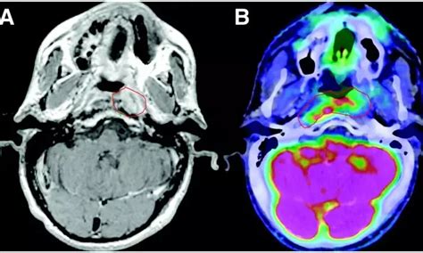 Checkpoint Inhibitors effective as first line treatment of recurrent or ...