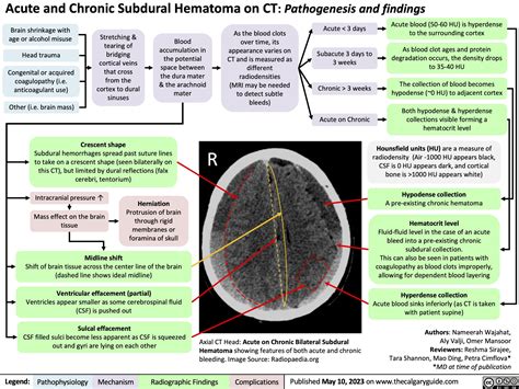 Subdural Hematoma on CT | Calgary GuideCalgary Guide