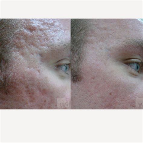 Tretinoin Before And After Scar