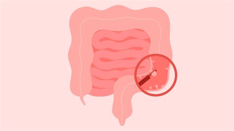 Everything You Need To Know About Colon Cancer | OnlyMyHealth