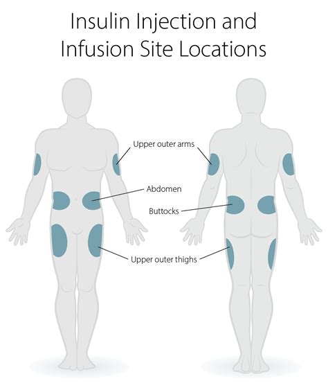Insulin Pen Injection Site Rotation at Cristina Lee blog