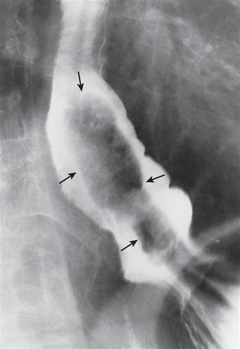 Benign Tumors of the Esophagus - Clinical Tree