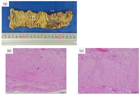 A Novel Treatment Strategy for Unresectable Locally Recurrent Rectal ...