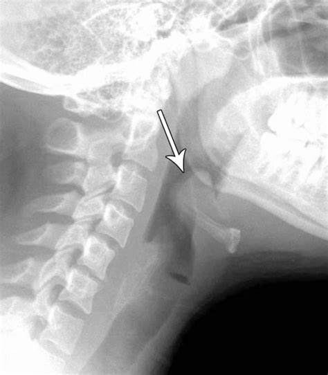 Epiglottitis Thumbprint Sign Imaging Acute Face And Neck Infections