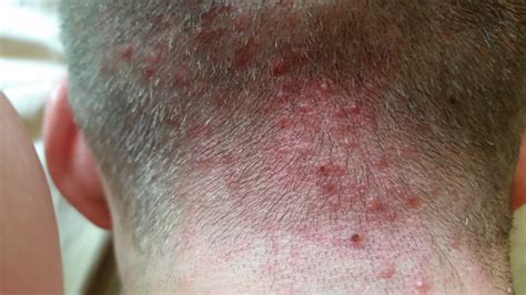 Rash On Neck And Back Of Head at Julie Hall blog