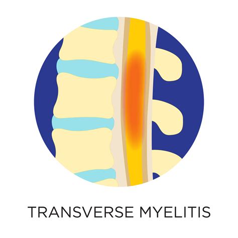 What Is Transverse Myelitis? | PainScale