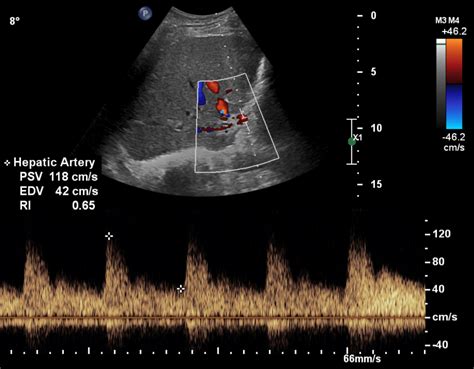 Early Liver Transplant Ultrasound | Radiology Article | Radshare.net