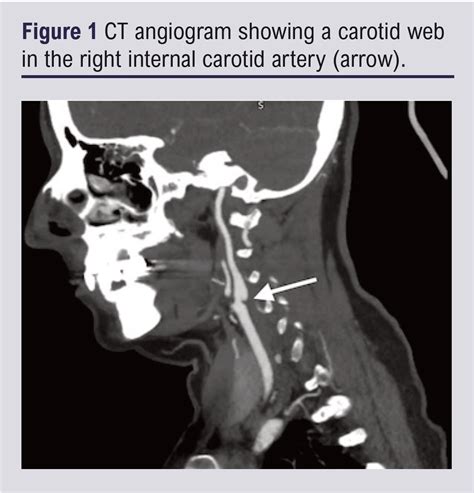 Carotid web: an important cause of stroke in young people – Journal of ...