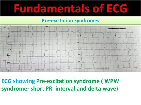 Approach to a patient with PR interval abnormality in ECG | PPSX
