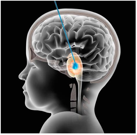 Convection Enhanced Delivery for Diffuse Intrinsic Pontine Glioma: Review of a Single ...