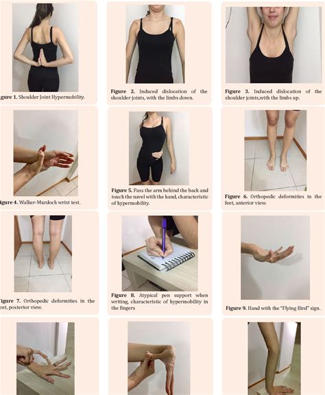 A Guide To Living With Ehlers-Danlos Syndrome (Hypermobility Type) at ...