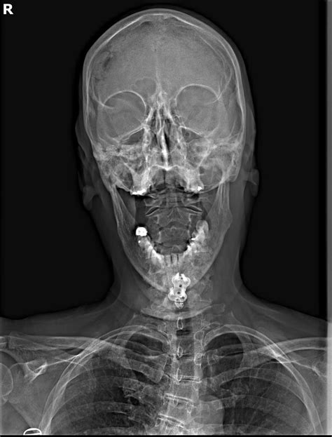 I got scanned for my brace and found out My Cobb angles are 24 degrees ...