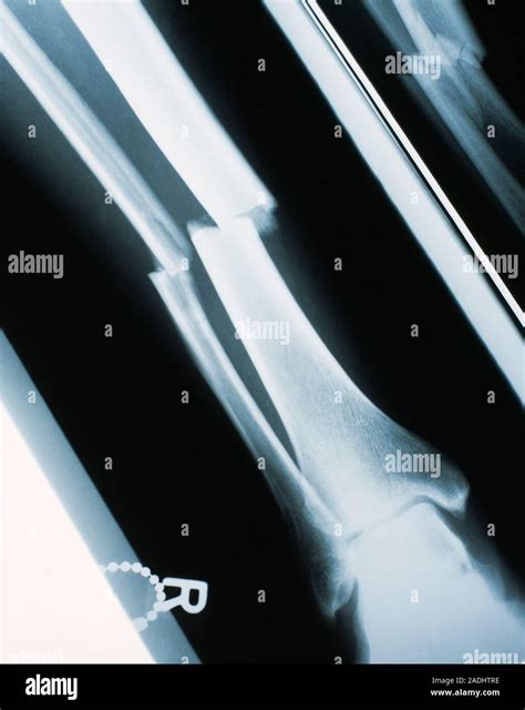 Lower leg fracture. X-ray of a fracture through the fibula (thinner, left) and tibia or shin ...