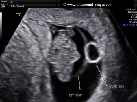 Bildergebnis für umbilical cord abnormalities ultrasound