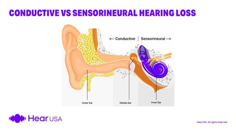 Sensorineural vs. Conductive Hearing Loss Explained