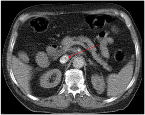 Eravacycline as Salvage Therapy for Severe Intra-Abdominal Infections ...