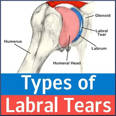 Types of Shoulder Labrum Tears - Sports Medicine Review